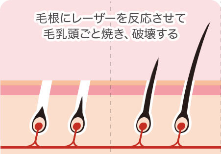 脱毛効果あり 毛根にレーザーを反応させて毛乳頭ごと焼き、破壊する