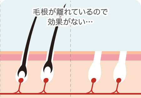 脱毛効果なし 毛根が離れているので効果がない…