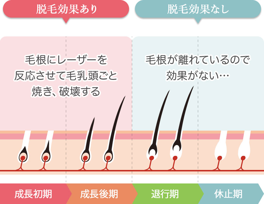 脱毛効果あり 毛根にレーザーを反応させて毛乳頭ごと焼き、破壊する