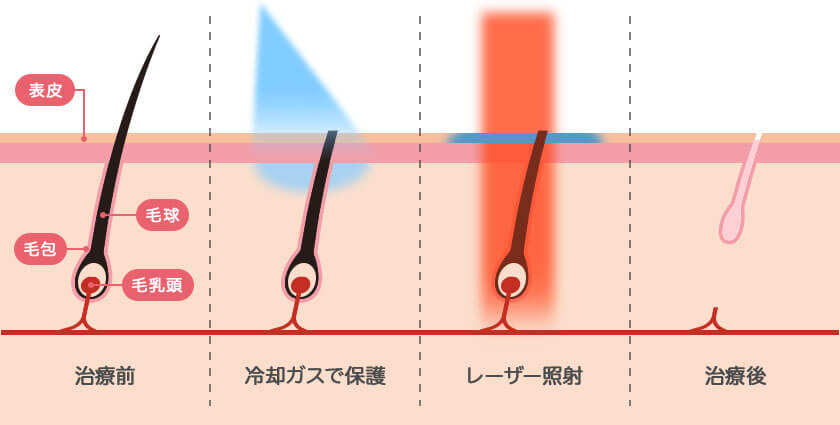 レーザー照射前に冷却装置が肌を保護だからお肌にやさしく、痛みが少ない