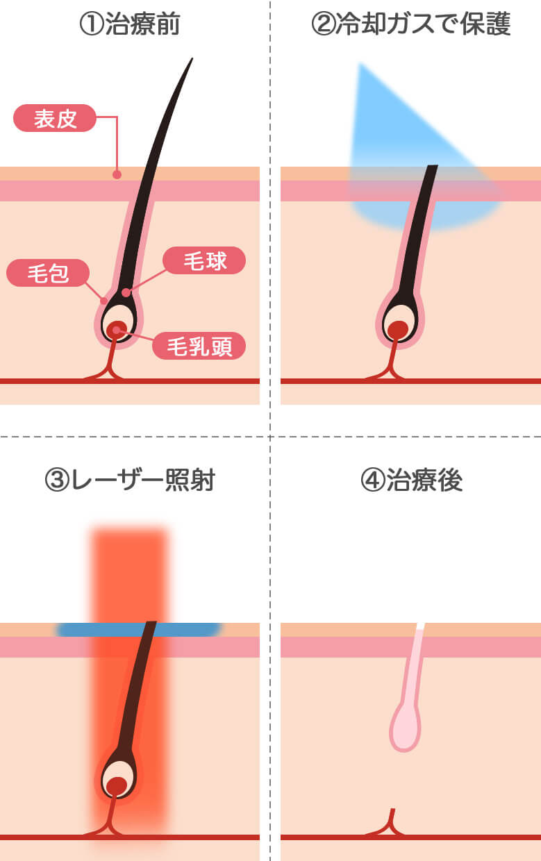 レーザー照射前に冷却装置が肌を保護だからお肌にやさしく、痛みが少ない