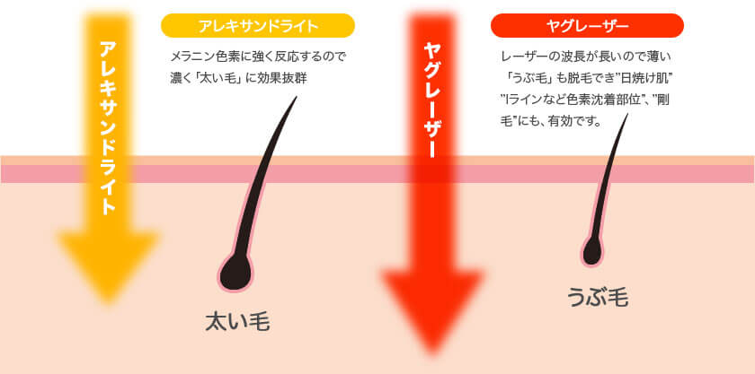 ２つのレーザー波長を使い分けられるからあらゆる毛質、肌質、肌色にも対応！