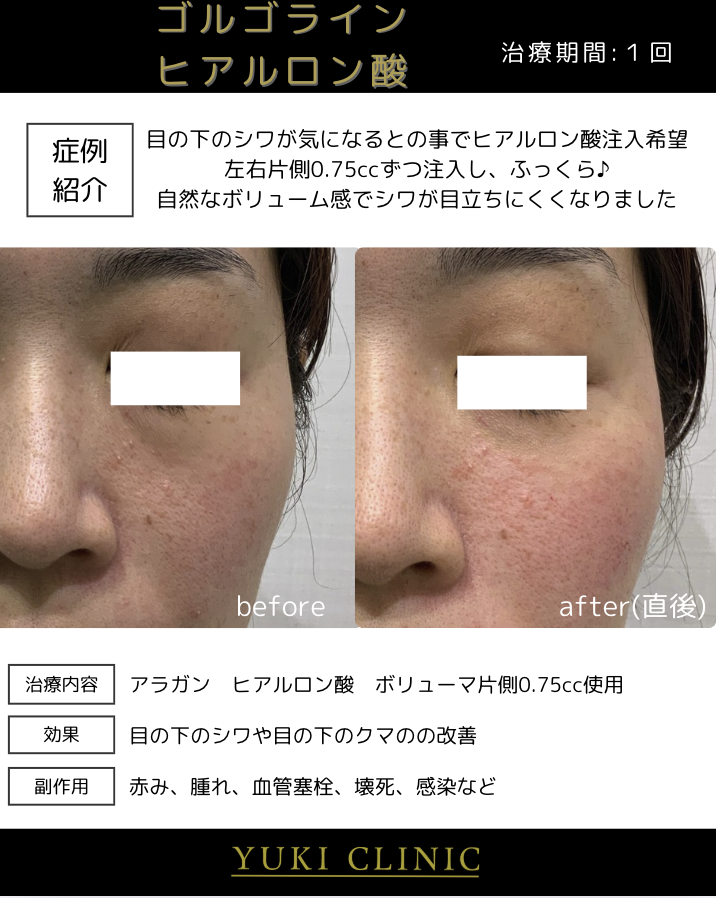 ゴルゴラインヒアルロン酸