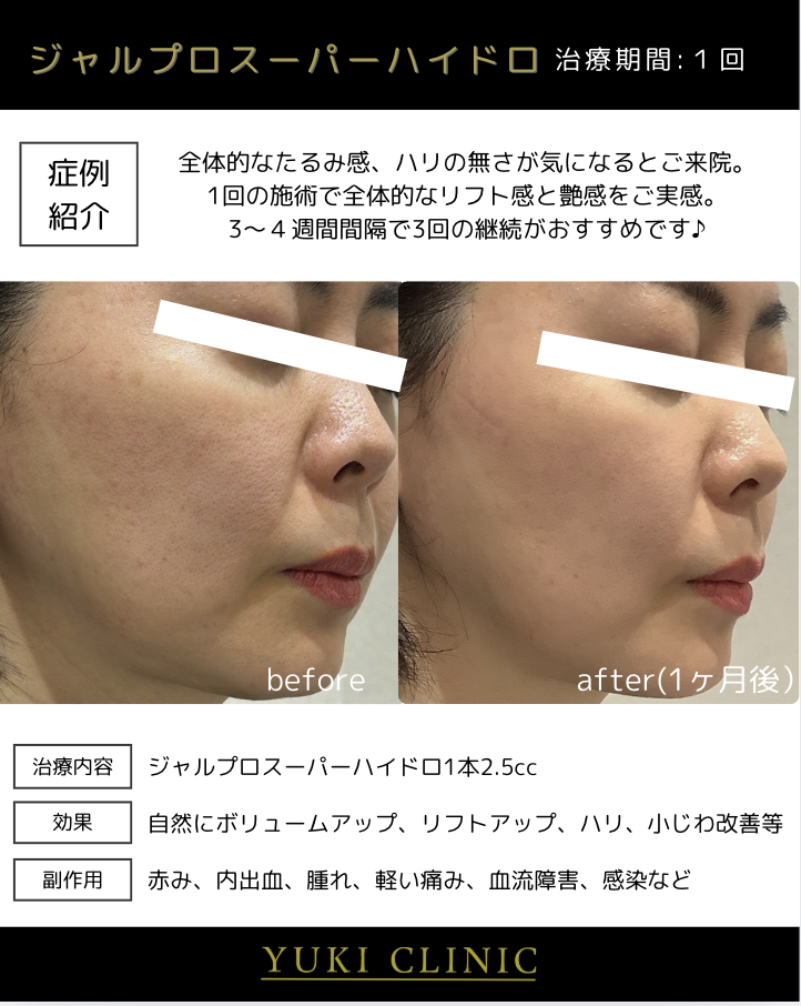 ジュルプロスーパーハイドロ