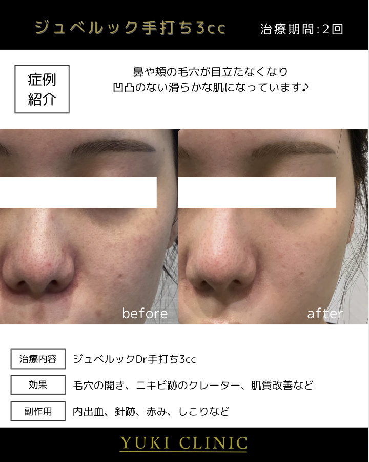 ジュベルック手打ち