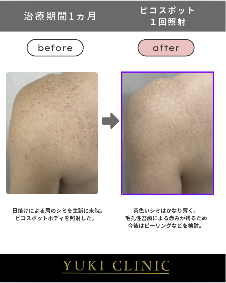 ピコスポットボディ