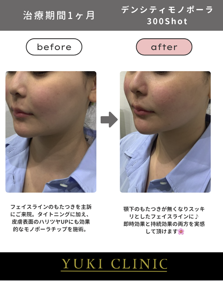 デンシティモノポーラ