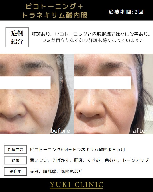 ピコトーニング