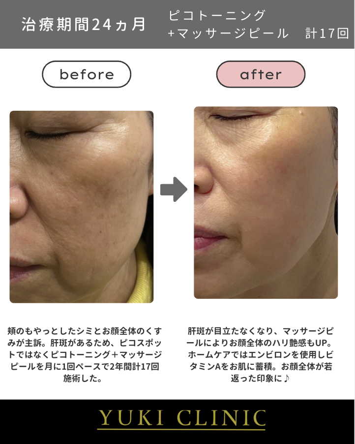 トーニング＋マッサージピール