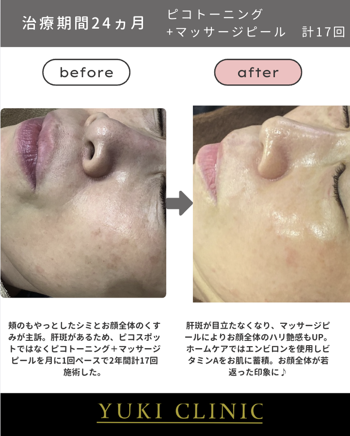 トーニング＋マッサージピール