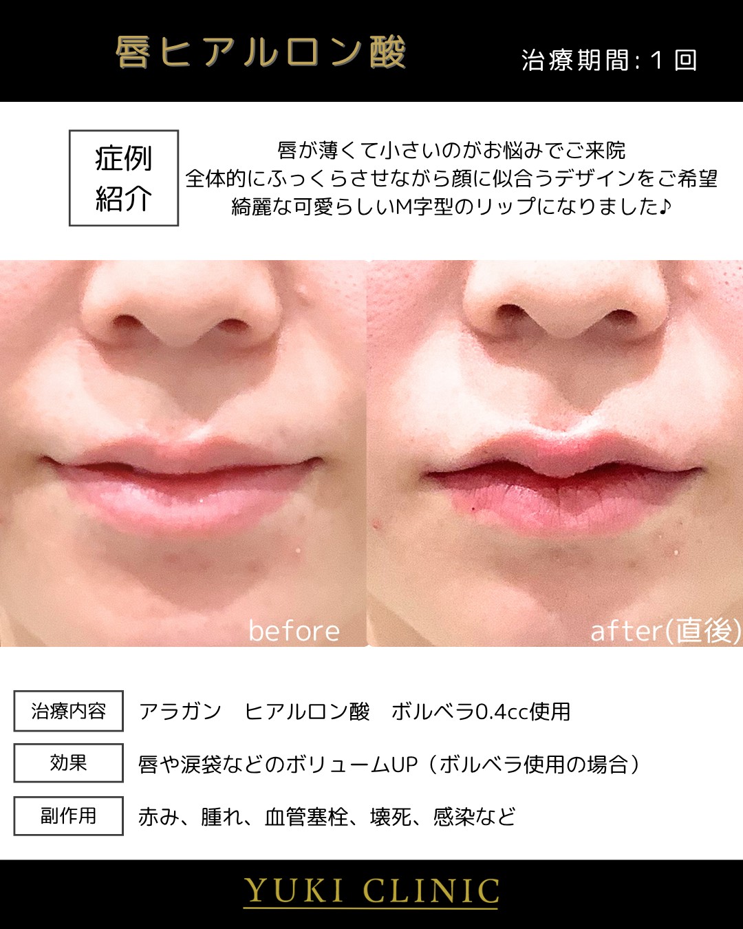 唇ヒアルロン酸