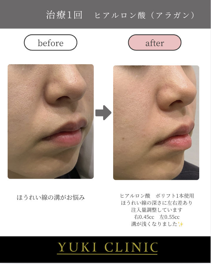 ほうれい線ヒアルロン酸