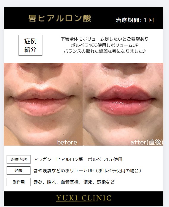 唇ヒアルロン酸
