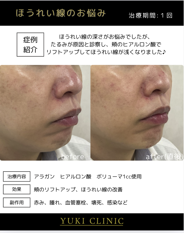 頬ヒアルロン酸