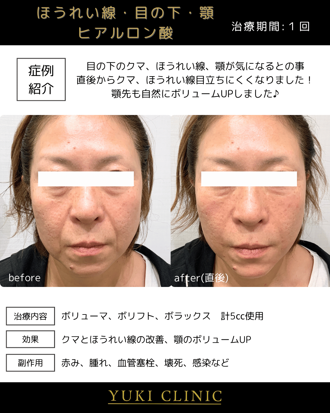 ほうれい線ヒアルロン酸