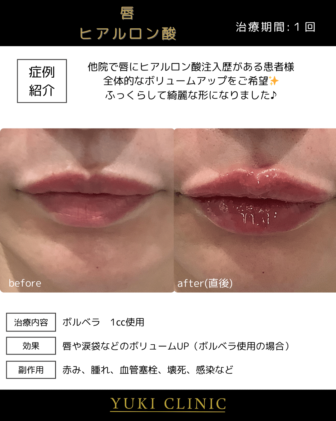 唇ヒアルロン酸