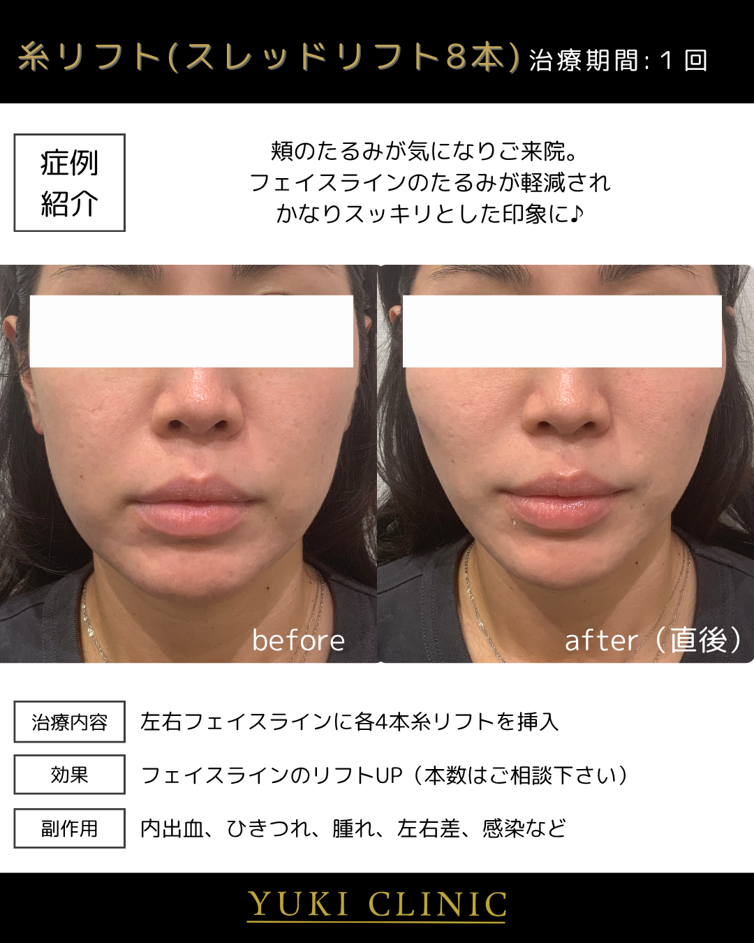 糸リフト