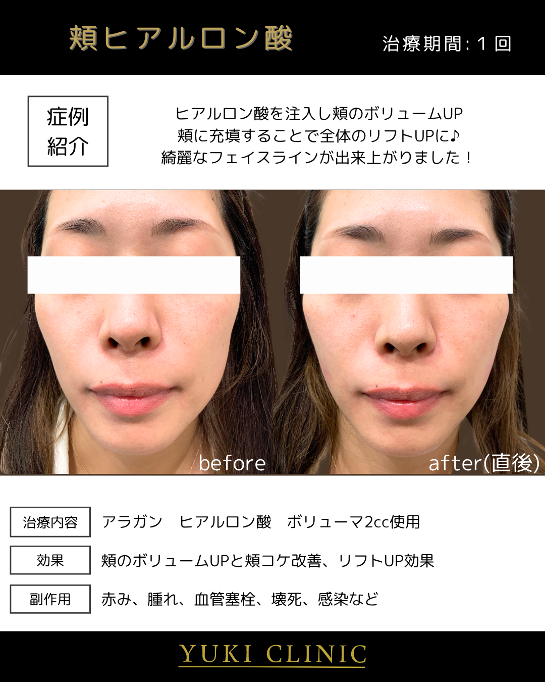 頬ヒアルリフトアップ