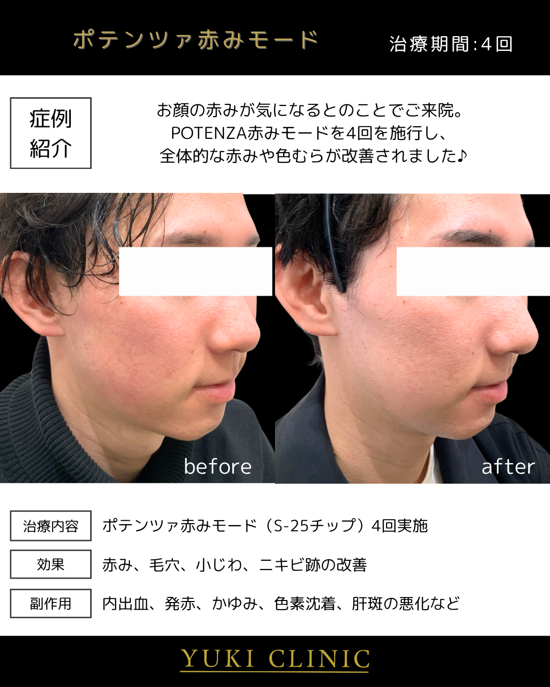 POTENZA　赤ら顔治療