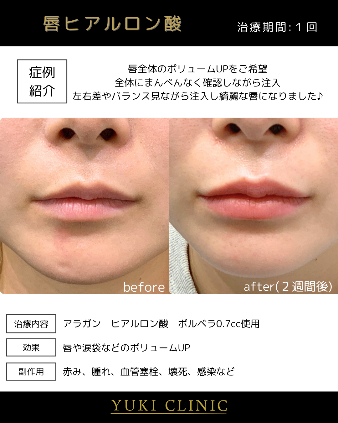唇ヒアルロン酸