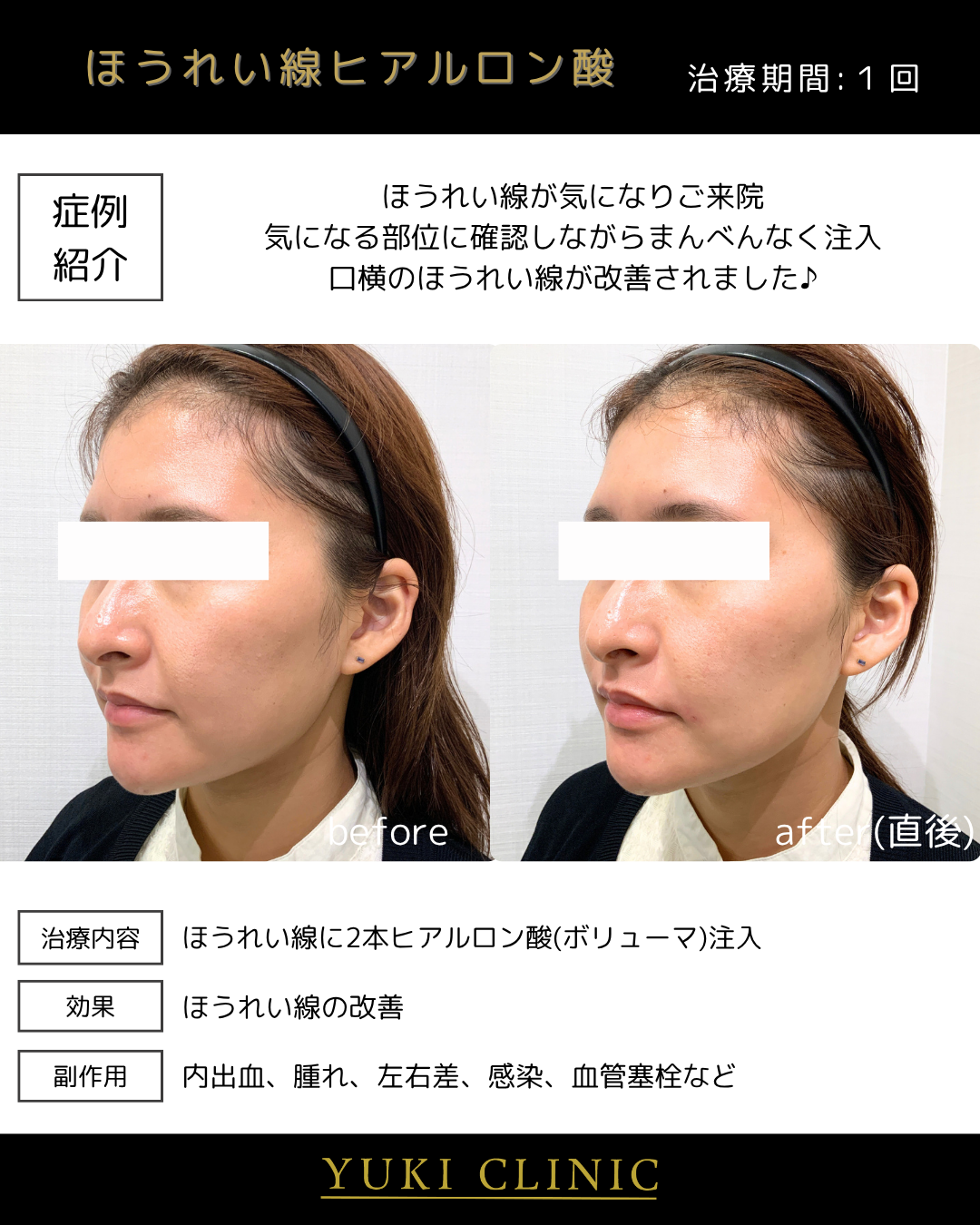ほうれい線ヒアルロン酸