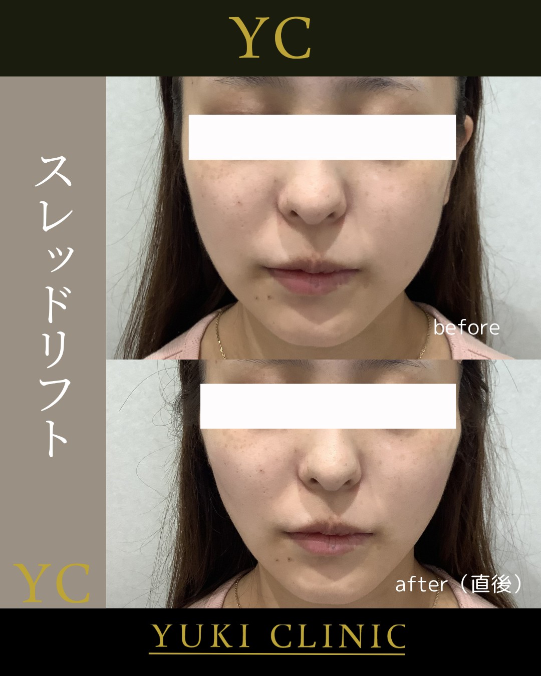 糸リフト
