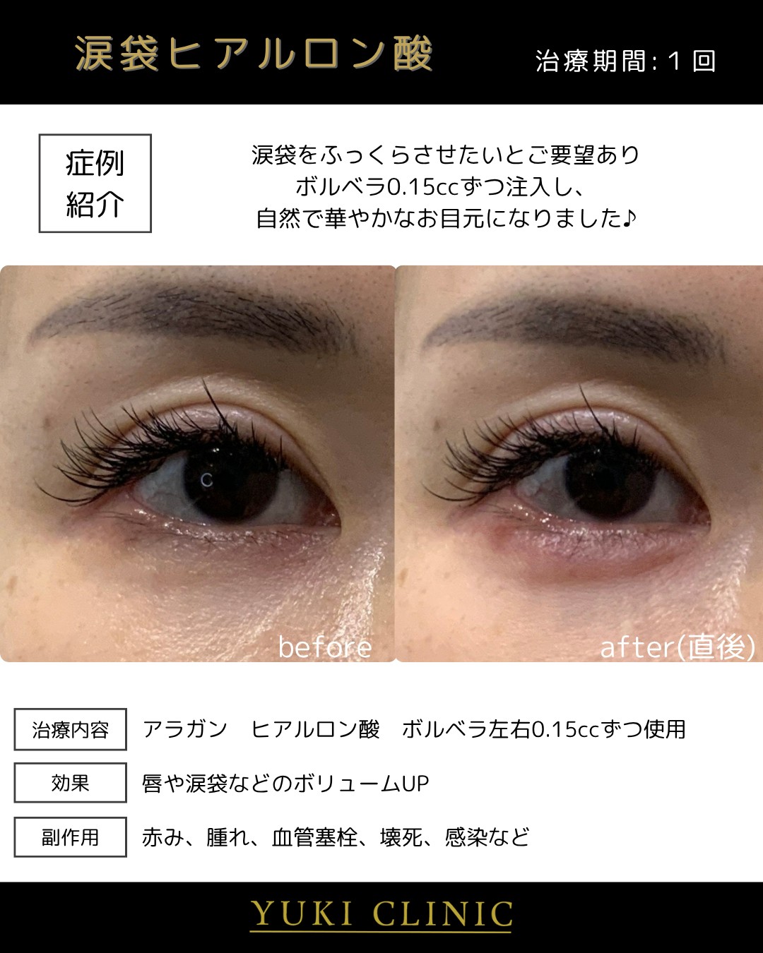 涙袋ヒアルロン酸