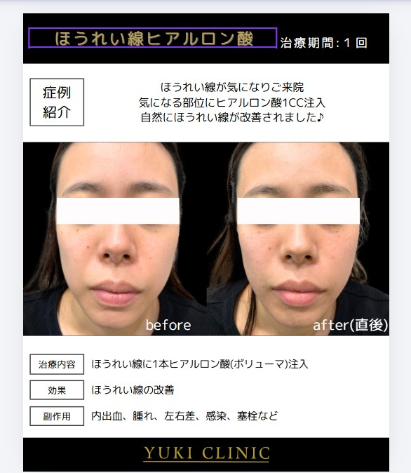 ほうれい線ヒアルロン酸
