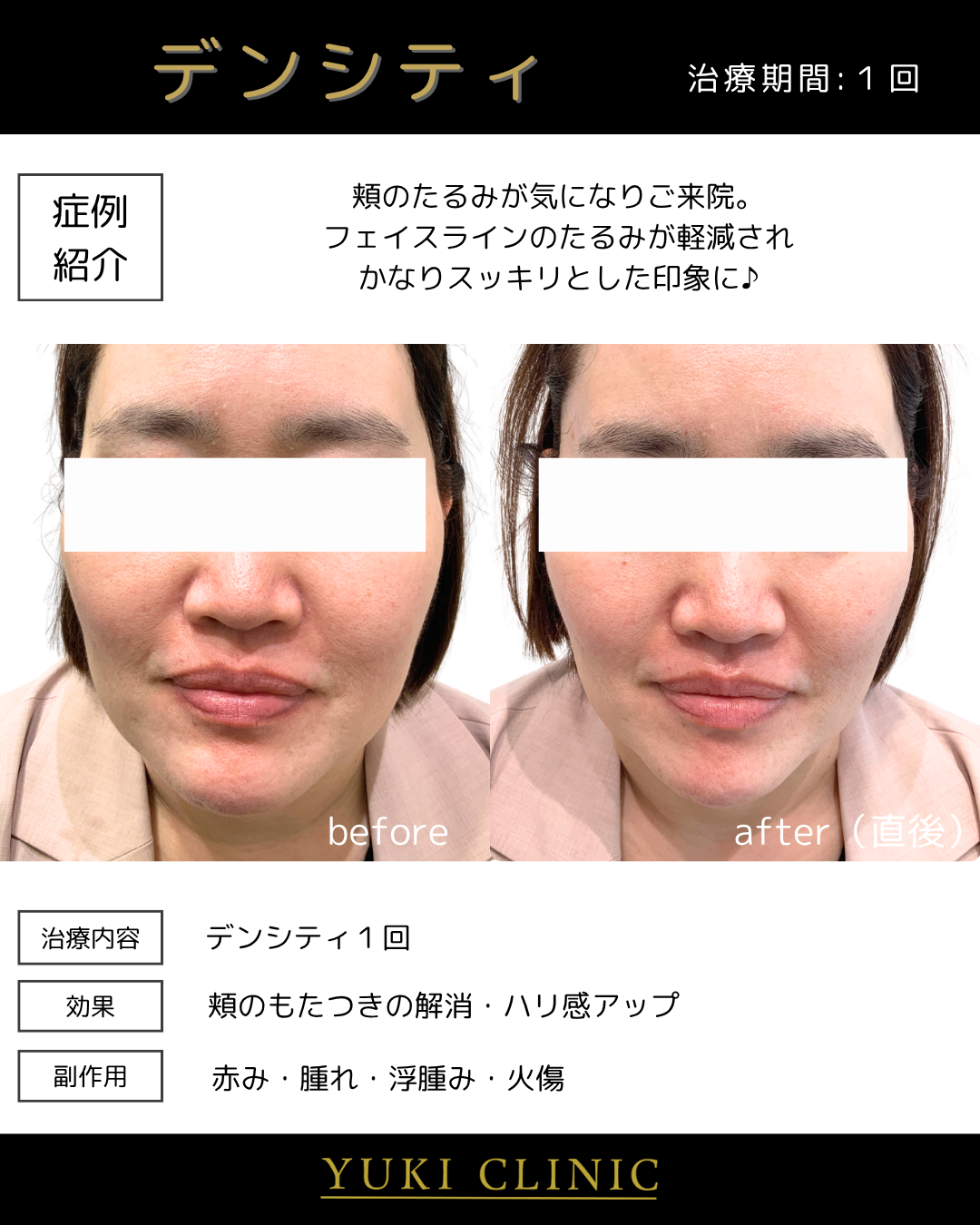 デンシティモノチップ
