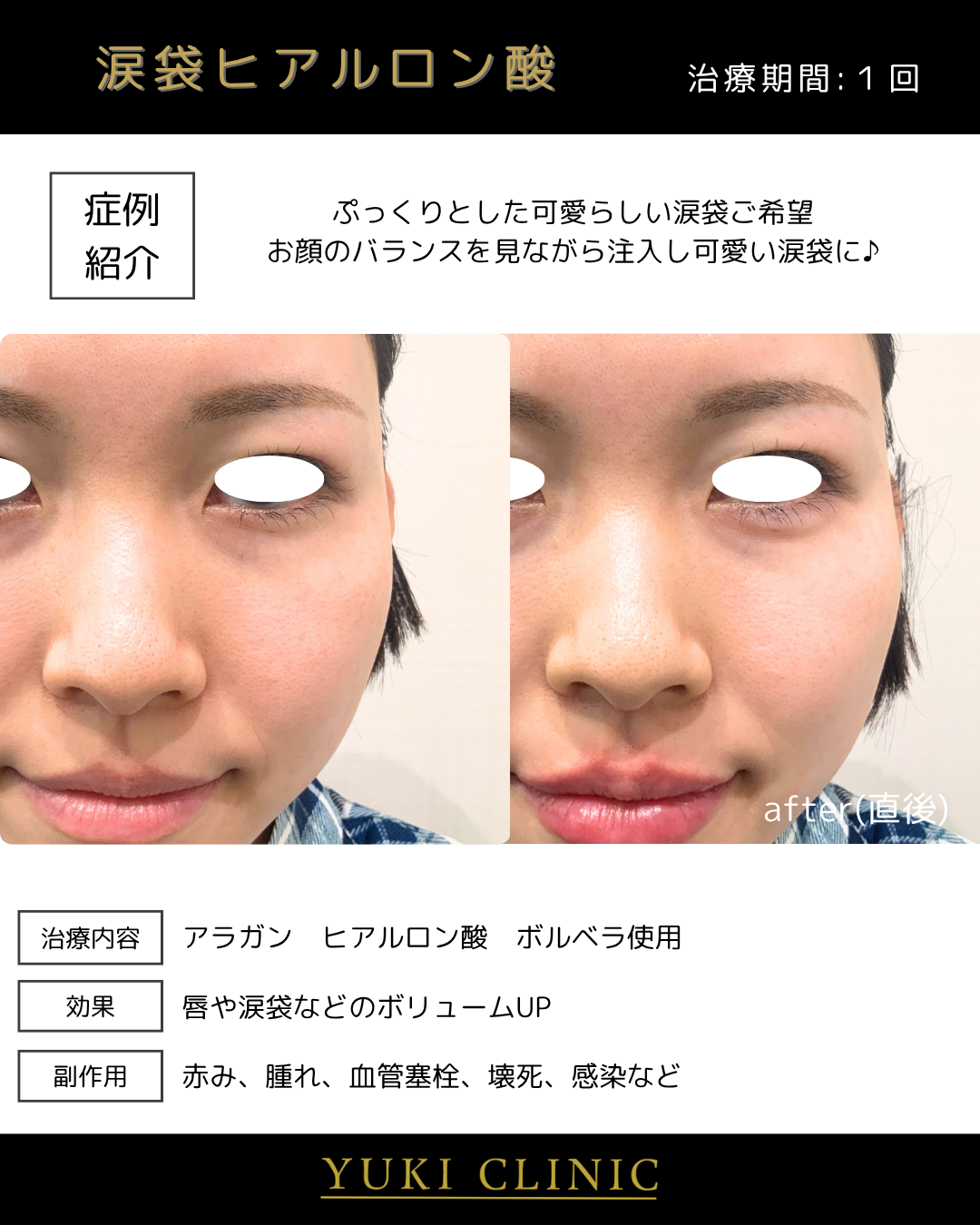 涙袋ヒアルロン酸