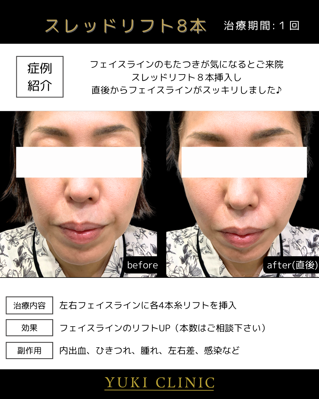 スレッドリフト