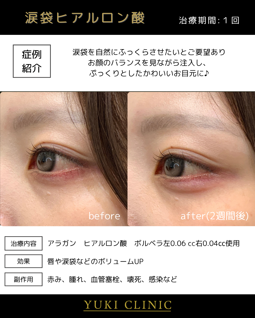 涙袋ヒアルロン酸