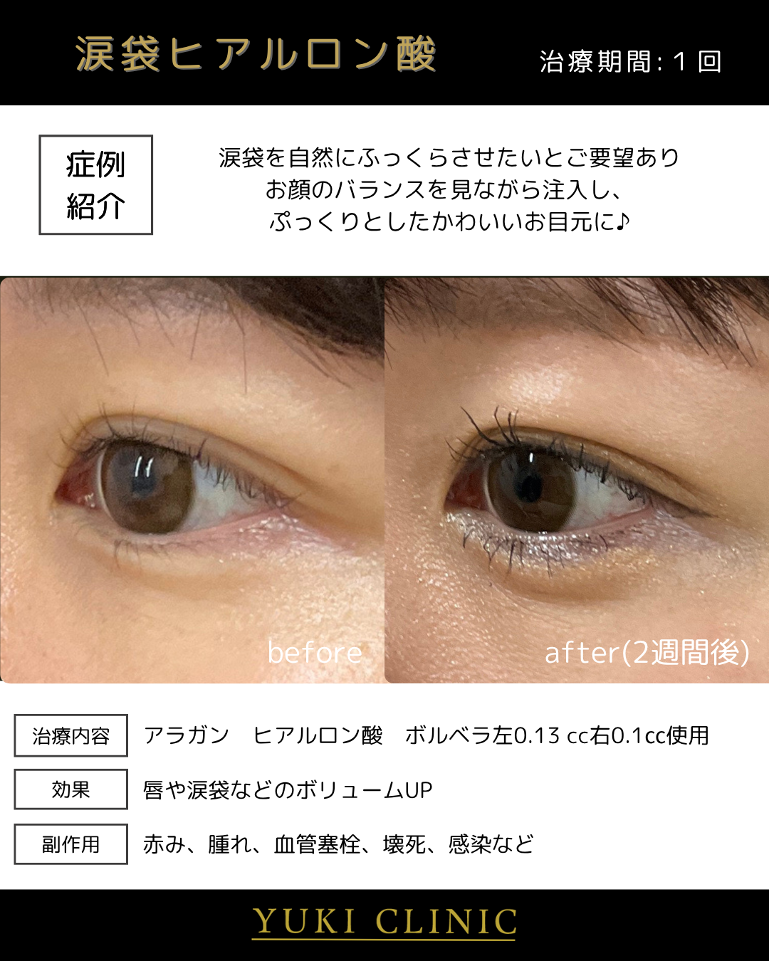 涙袋ヒアルロン酸（ナチュラルな形）