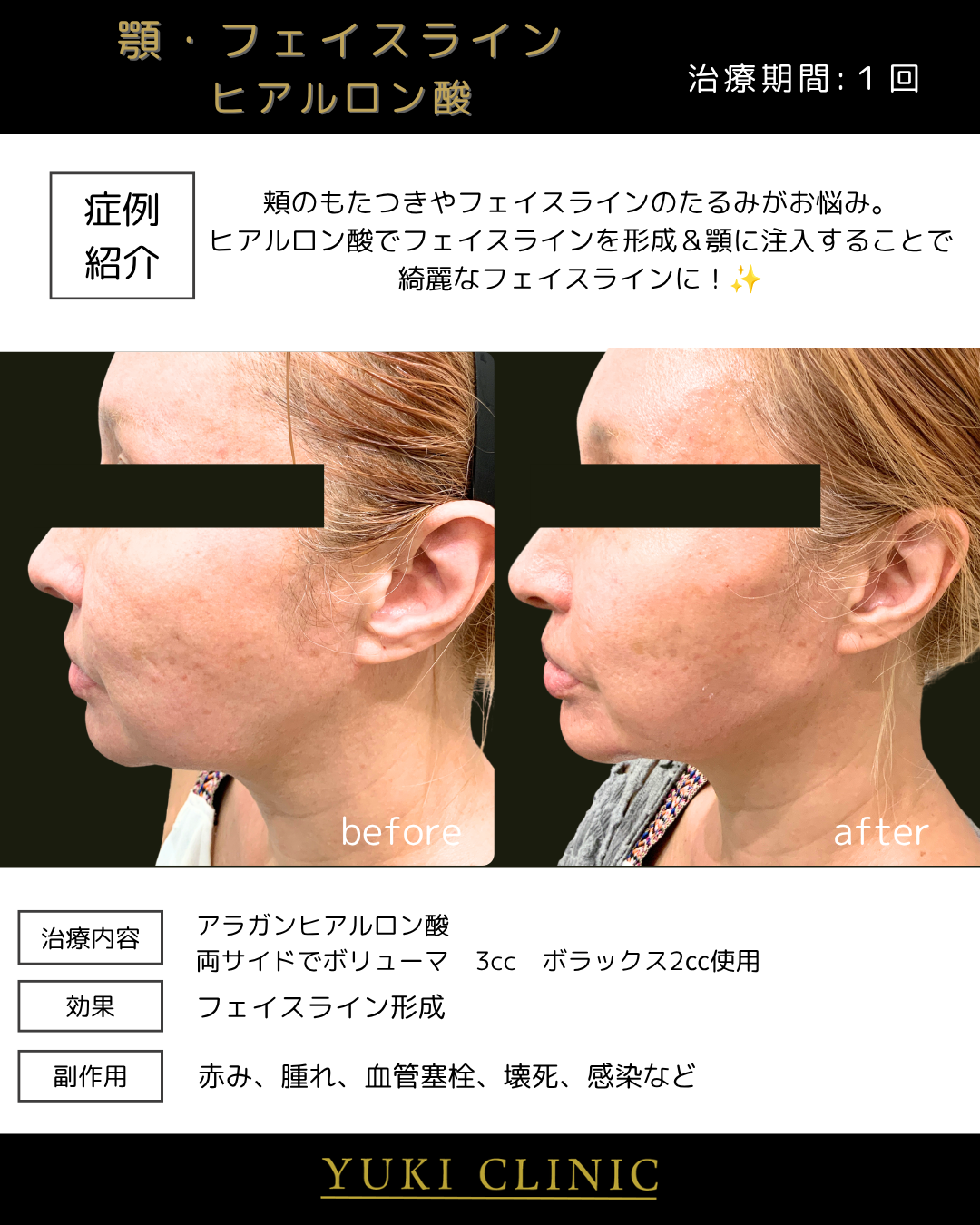 フェイスライン形成（ヒアルロン酸）