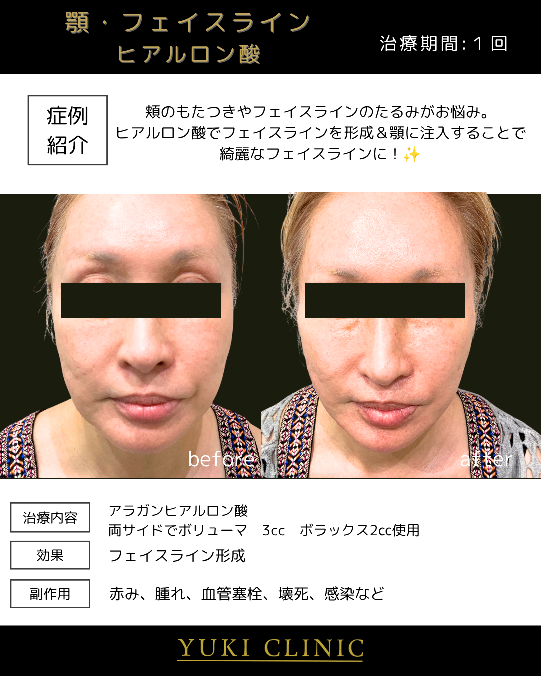 フェイスライン形成（ヒアルロン酸）