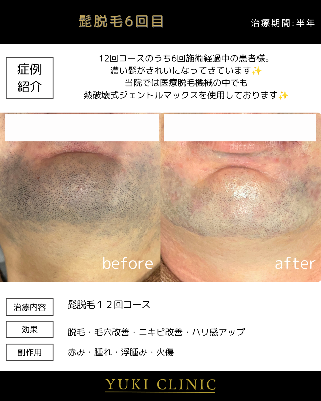 髭脱毛６回