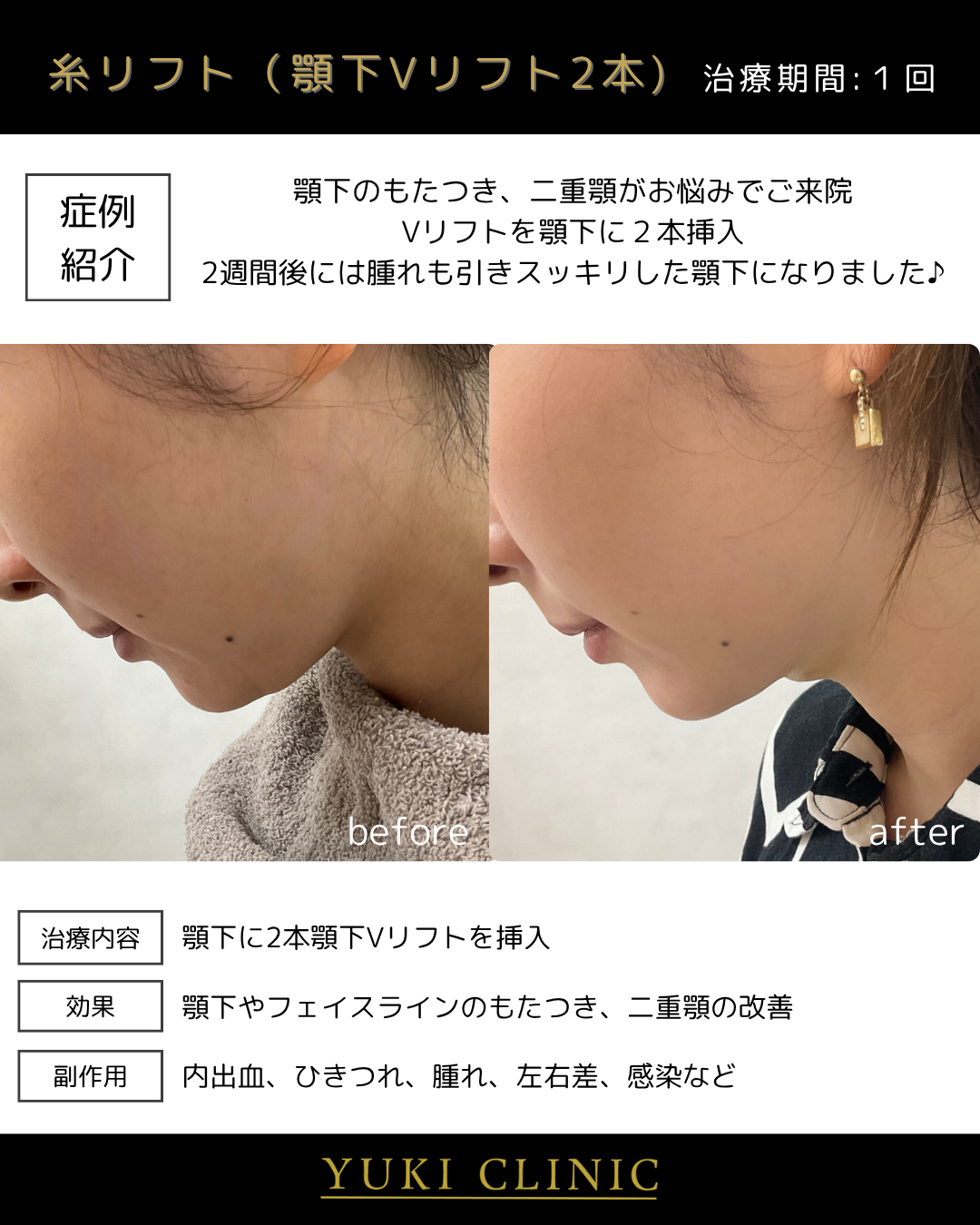顎下Vリフト