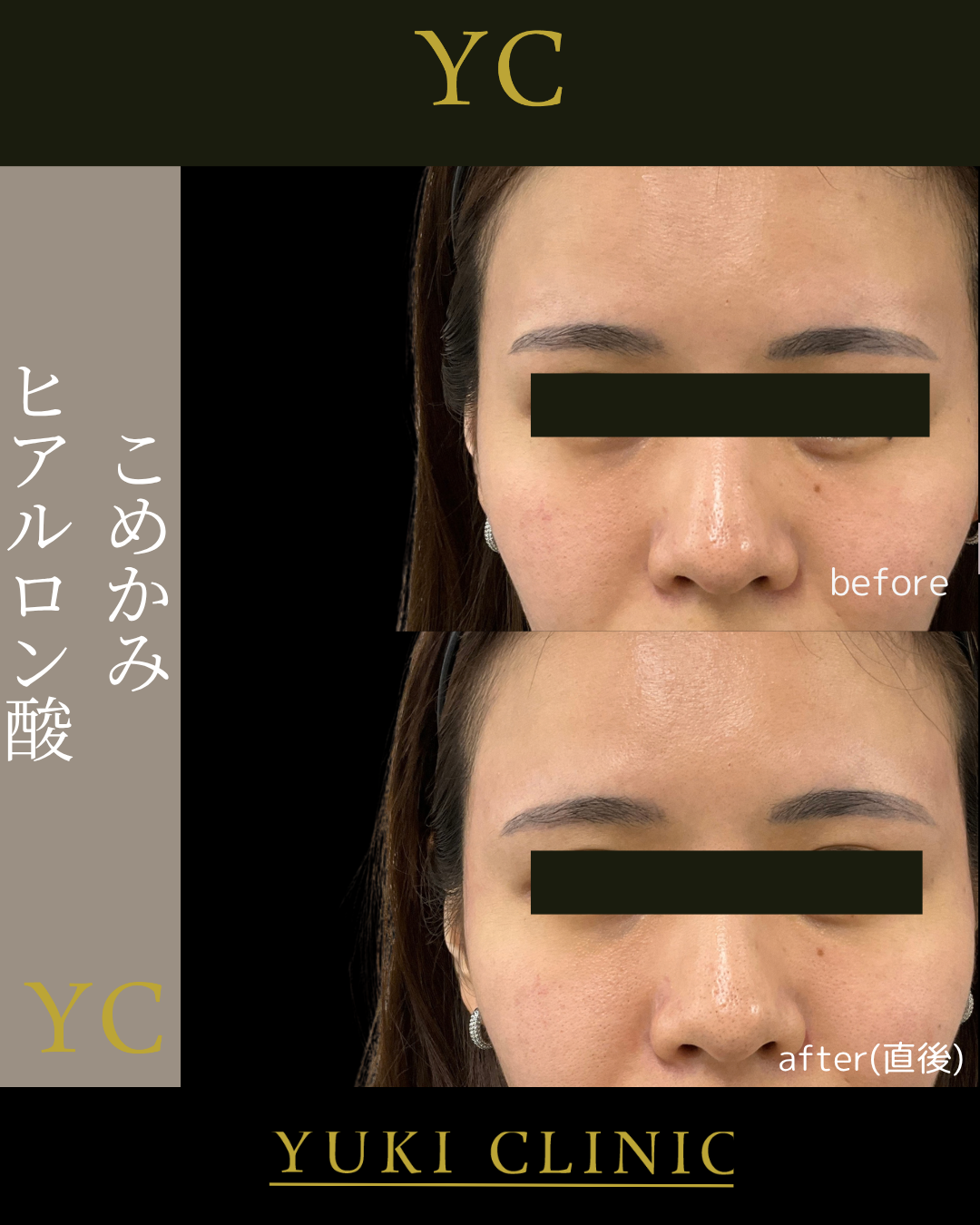 ヒアルロン酸こめかみ修正