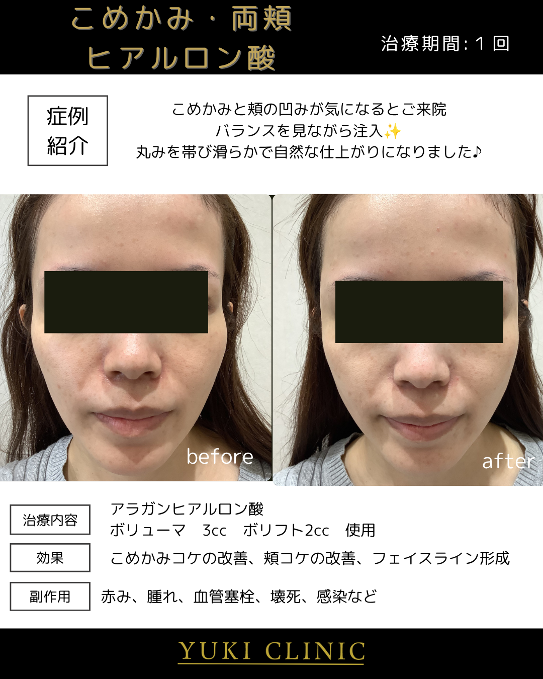 こめかみヒアルロン酸