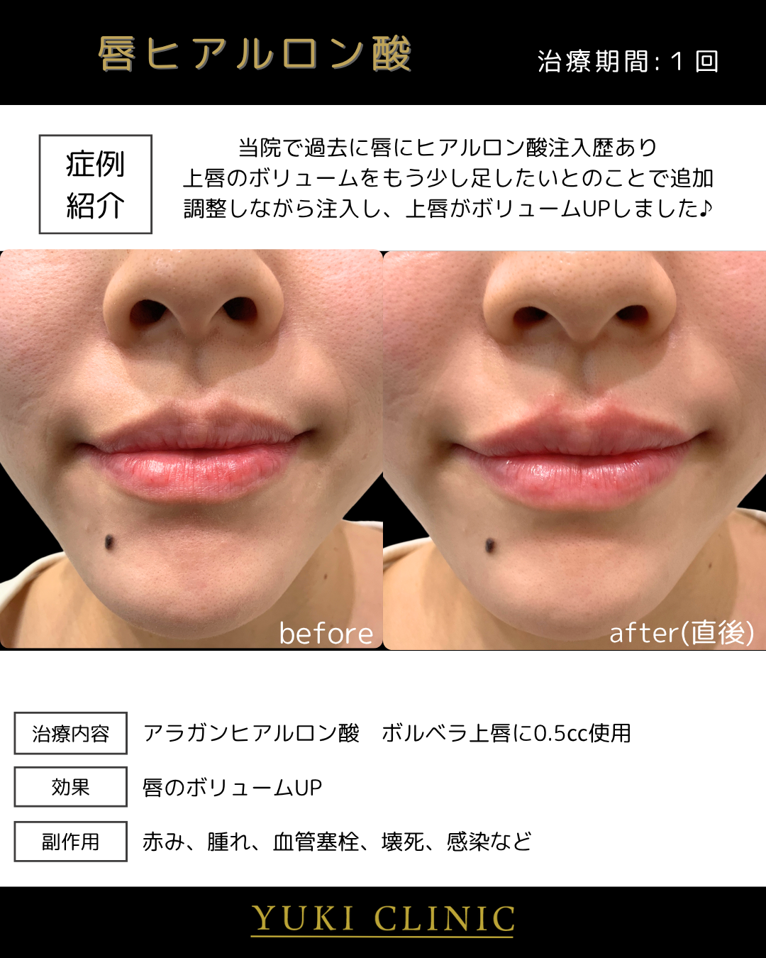 唇ヒアルロン酸