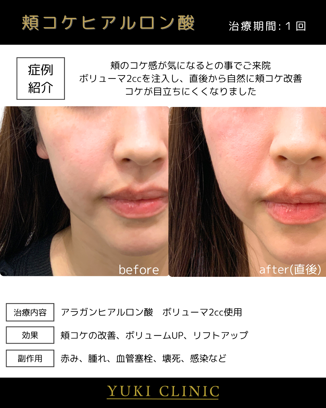 頬ヒアルロン酸