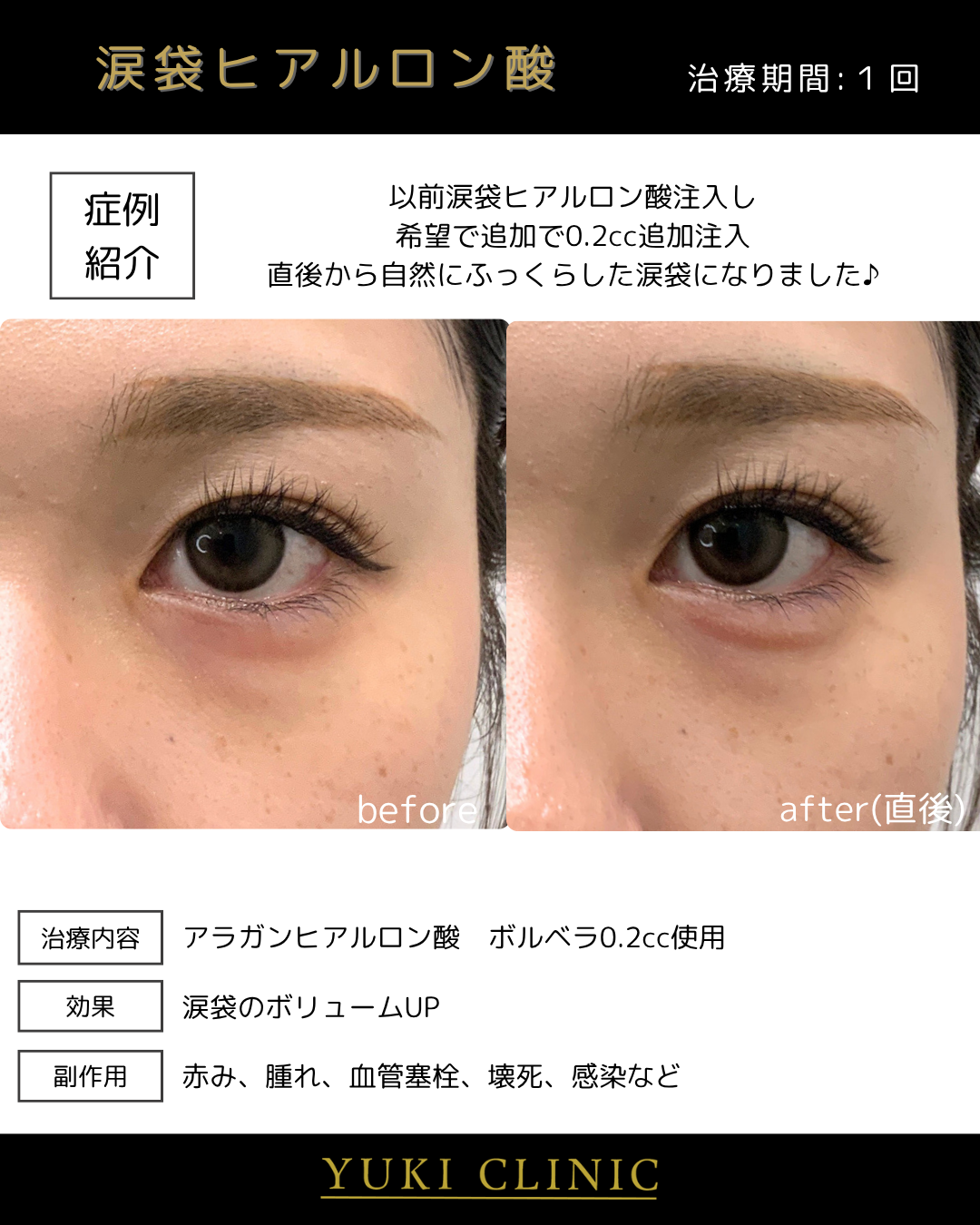 涙袋ヒアルロン酸