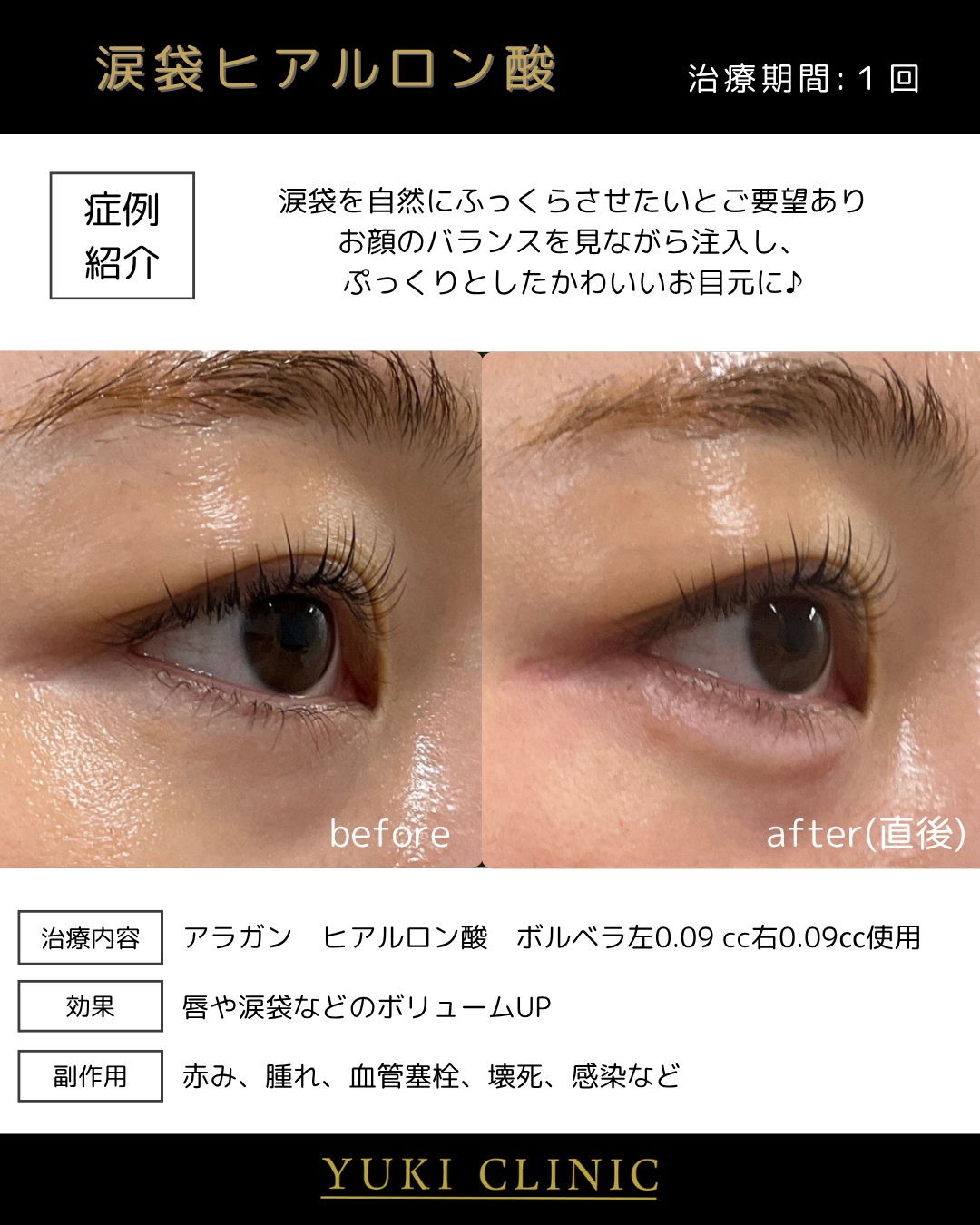 涙袋ヒアルロン酸