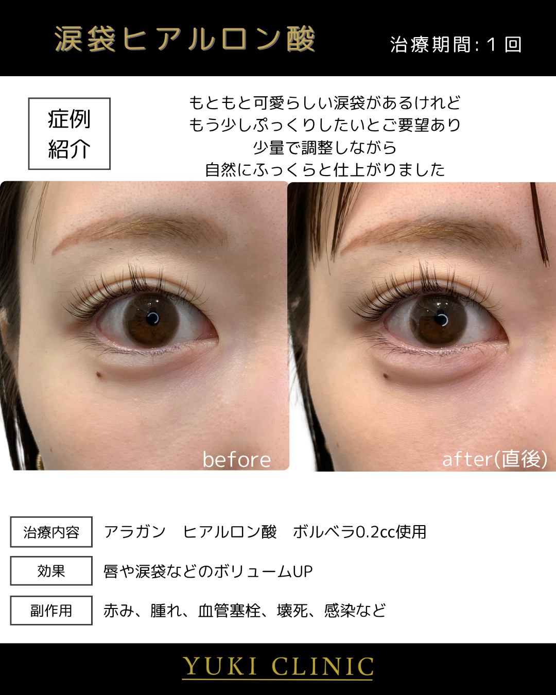 涙袋ヒアルロン酸