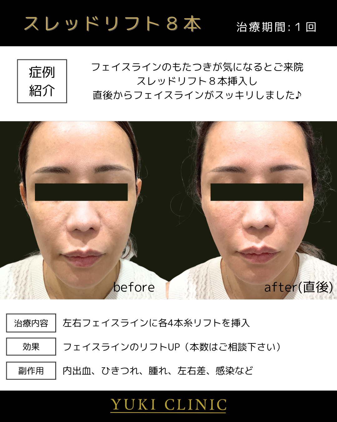 スレッドリフト