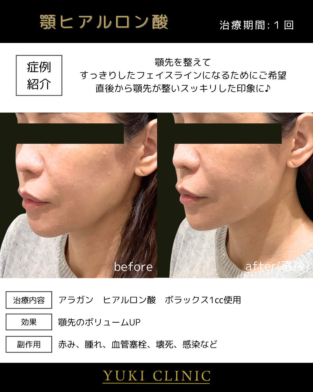 あごヒアルロン酸