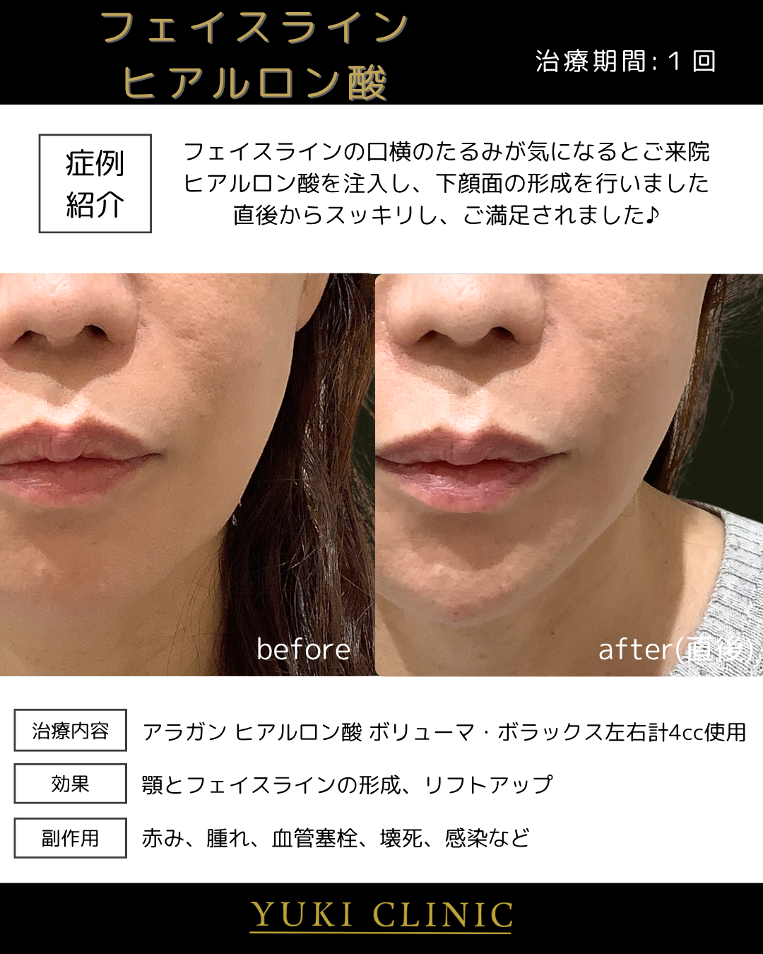 フェイスラインヒアルロン酸